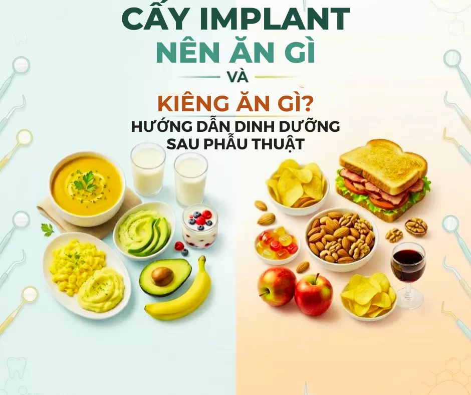 Cấy Implant nên ăn gì và kiêng ăn gì? Hướng dẫn dinh dưỡng sau phẫu thuật