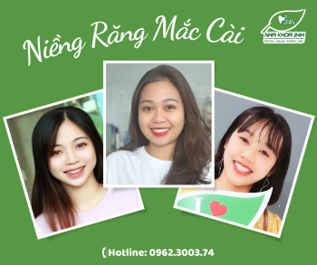 NIỀNG RĂNG MẮC CÀI LÀ GÌ?