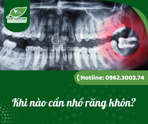 KHI NÀO CẦN NHỔ RĂNG KHÔN