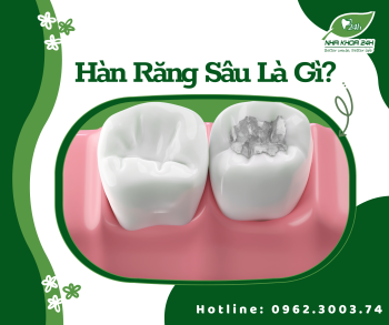 HÀN RĂNG SÂU VÀ NHỮNG THÔNG TIN CẦN BIẾT