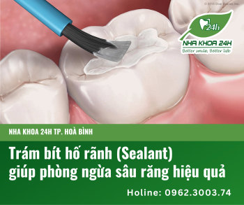 TRÁM BÍT HỐ RÃNH (SEALANT) GIÚP PHÒNG NGỪA SÂU RĂNG HIỆU QUẢ