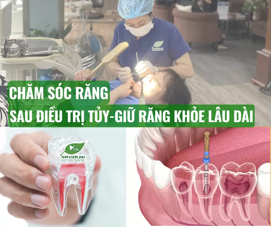 CHĂM SÓC RĂNG SAU ĐIỀU TRỊ TỦY
