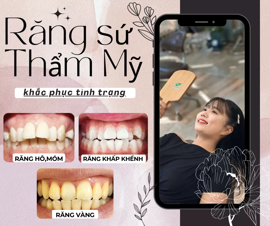 Răng Sứ Thẩm Mỹ – Giải Pháp Khắc Phục Khuyết Điểm Nụ Cười