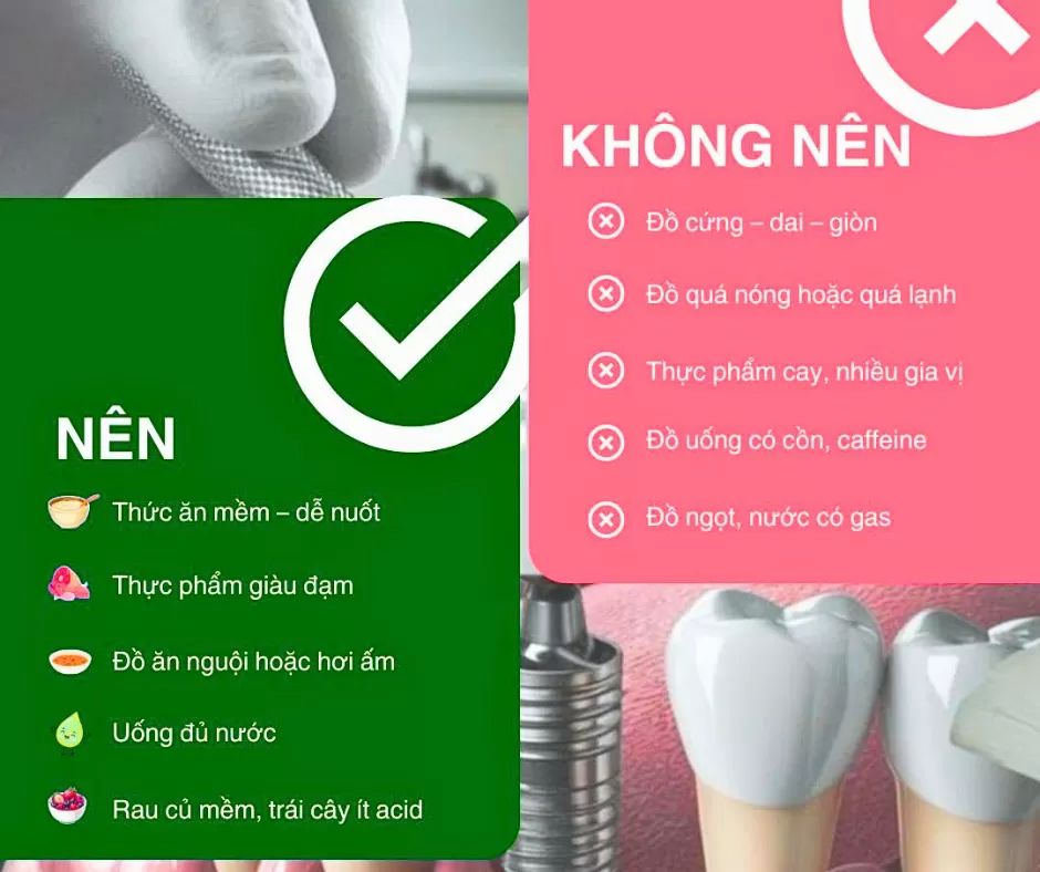 Cấy Implant nên ăn gì và kiêng ăn gì? Hướng dẫn dinh dưỡng sau phẫu thuật