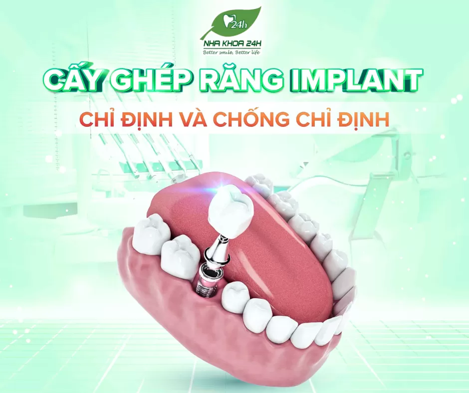 Cấy Ghép Răng Implant – Chỉ Định Và Chống Chỉ Định