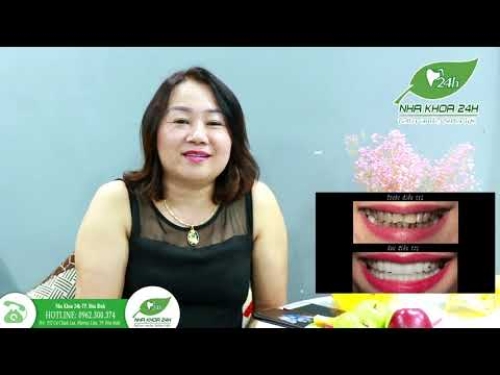 Bệnh nhân Thẩm mỹ 20 răng sứ Diamond Glass tại Nha Khoa 24H-TP. Hòa Bình